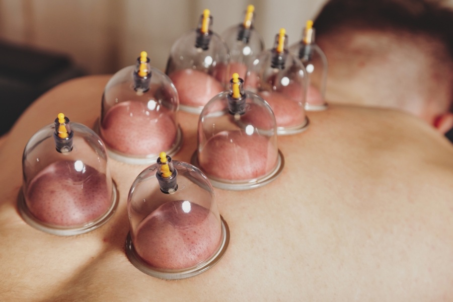 Les ventouses : une thérapie ancestrale au service de votre corps